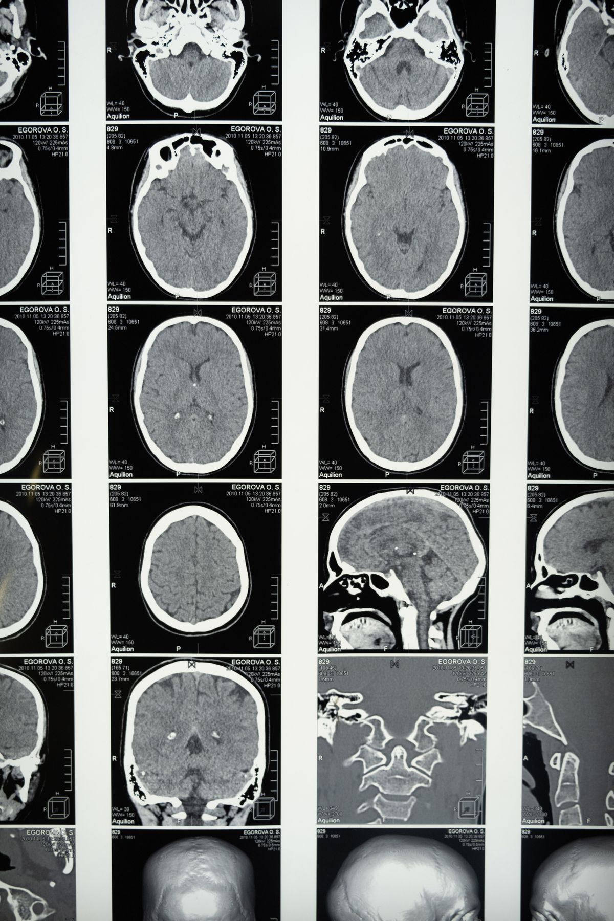Neurobiología de la adicción: qué ocurre realmente en el cerebro